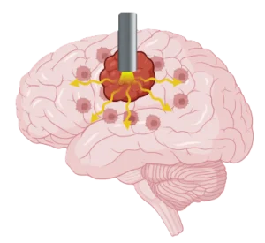 GlioLighT Project - D